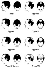 Medical Baldness Chart| Hamilton Norwood Scale