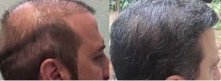 Hair Transplant Clinic in Los Angeles, CA Hair Transplant Clinic in Los Angeles, CA