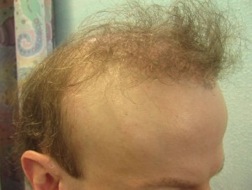 Before temple hair restoration with the UGraft | example of missing temples Before Temple Hair Restoration with the UGraft | missing temple points
