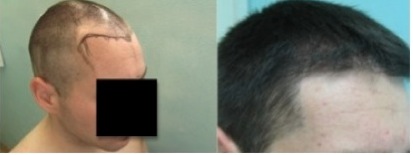 Temple Hair Restoration by UGraft Advanced FUE|before & after surgery