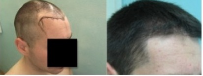 temple hair restoration by UGraft advanced FUE| results of patient's procedure Temple Hair Restoration by UGraft Advanced FUE|before & after surgery