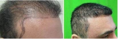 temple hair restoration by Dr U |repair surgery results Temple Hair Restoration by Dr U |new results on patient