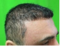 Temple Hair Transplant | patient results