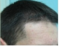 Temple Hair Transplant 5