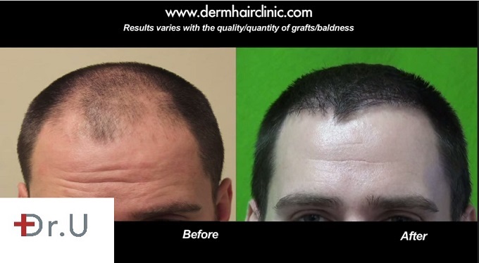 New Hairline Results of Follicular Unit Extraction using 1500 grafts