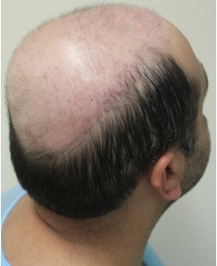 Severely Bald Patient Before BHT