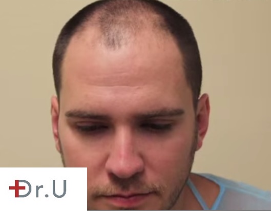 Before Follicular Unit Extraction using 1500 grafts