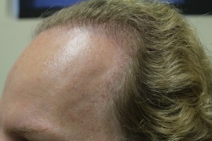 hairpiece versus FUE hair transplant results