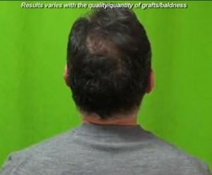 Patient after his crown hair restoration surgery using Follicular Unit Extraction