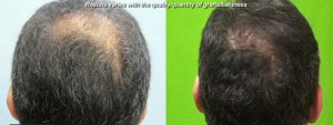 Before and after Follicular Unit Extraction Crown Restoration Using 1200 Grafts
