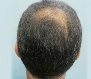 Patient before his Follicular Unit Extraction to correct baldness in his crown area