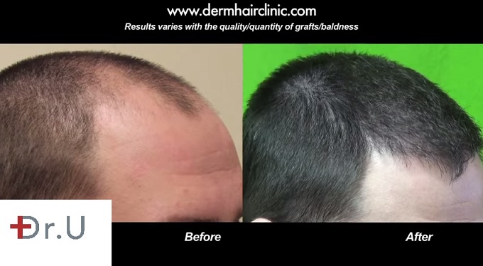 FUE Hair Transplantation Using 1500 grafts For Hairline Restoration - Side View Showing Restored Temples 