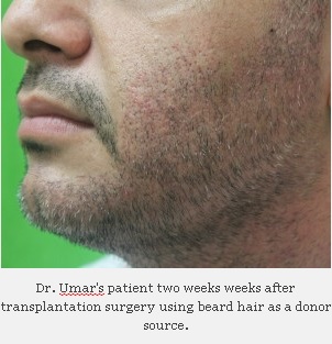 UGraft Hair Restoration Using Facial Hair, Donor area at Just 2 weeks