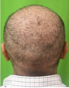 Gentle care is needed to avoid Hair transplant grafts dislodging in the immediate aftermath of surgery