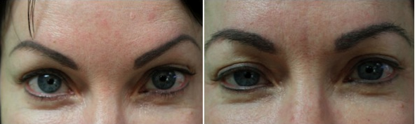 eyebrow hair transplant process completed by this patient, photo show before and after the process eyebrow hair transplant process completed by this patient, photo show before and after the process