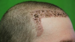 Hair Transplant Cost Factors