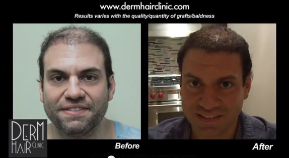 Hair Restoration Graft Calculation - DermHair Clinic . 1-310-318-1500
