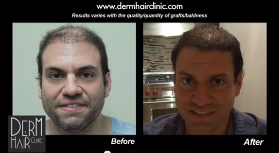 Hair restoration graft calculation: Calculating How Many Hair Grafts You’ll Need