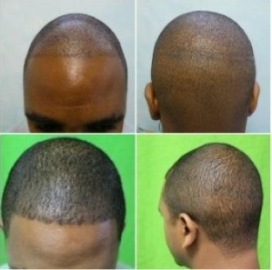 Follicular Unit Extraction for Black Male Patient