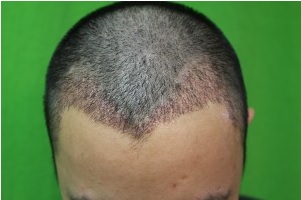 What Is the downtime after FUE hair transplant - Scabs