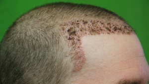 What to Expect in FUE hair transplant Surgery