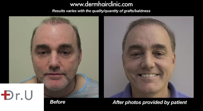 Patient's New Hairline & Temples| Before and After Photos