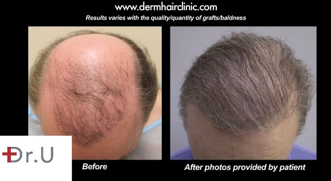 Frontal Scalp View | Hair Island - Repair Surgery 5000 Grafts