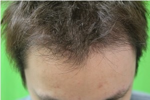 FUE hairline results for Asian Patient