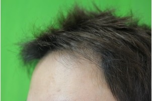 Hair Transplant Results on Asian Patient, hair restoration for Asian people