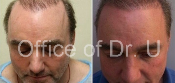 Hair Repair Patient|Before & After 5000 Grafts
