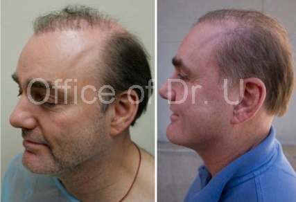 Profile View of Body Hair Transplant Repair|Before and After Photos