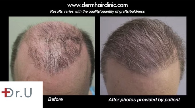 Botched Hair Transplant Images, befor and after Beard Hair to head Transplant using 5000 grafts Repair