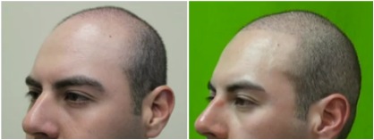 Follicular Unit Extraction | Diffuse Hairline and Coverage