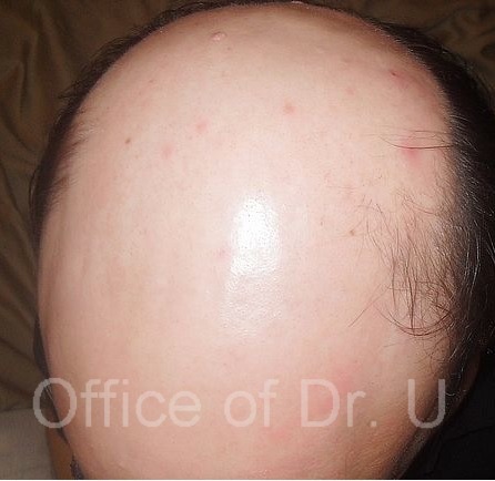 Norwood 7 extreme baldness| Patient before his procedure