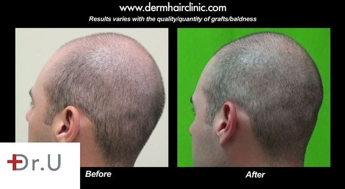 Bald Spot on FUE Patient's Head| Before and After