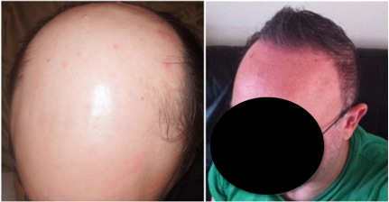 Hair Transplantation Donor Hair Sources - Results after using head and beard donors by UGraft