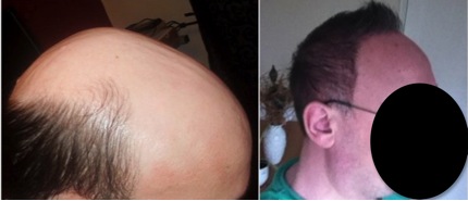 Before and After Beard Hair Transplant