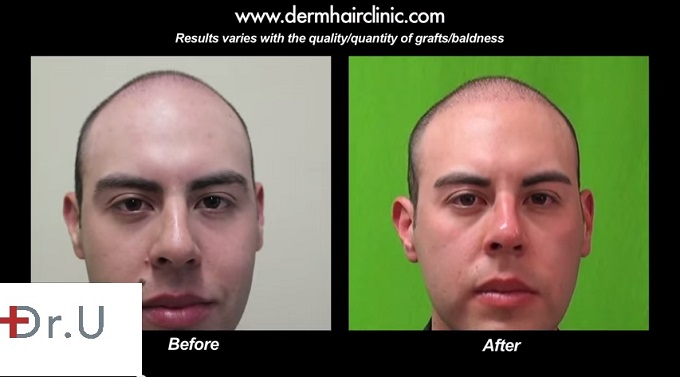 Full Face View of Young Male FUE Patient| Before and After Surgery