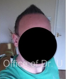 Front View| Severe Baldness Reversed Front View| Severe Baldness Reversed
