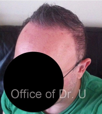 View of Patient's Frontal Scalp| Body Hair Transplant For Severe Baldness