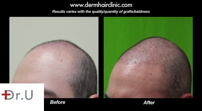 FUE Hairline Advancement| New Hairline Placement