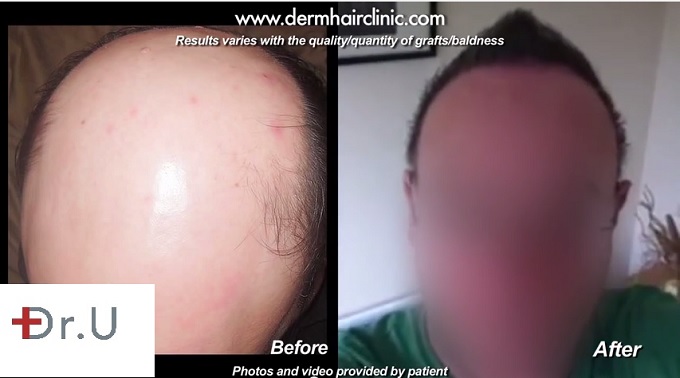 Front View of Patient's Head| Before and After Hair Transplant For Severe Baldness