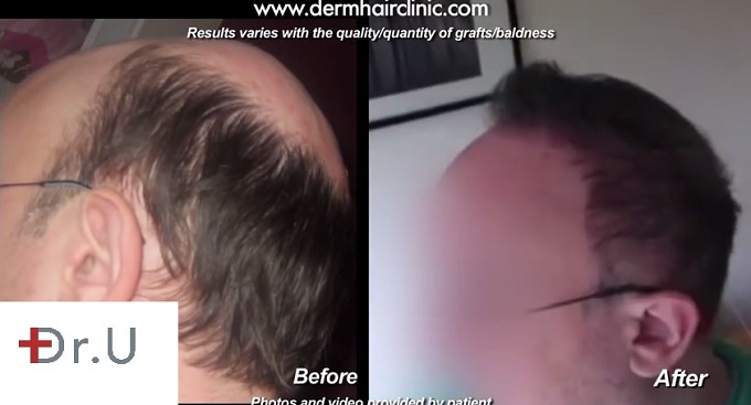 Body Hair Transplant using 10,500 grafts : Photos of NW 7 Patient's Results Body Hair Transplant using 10,500 grafts : Photos of NW 7 Patient's Results