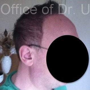 View Showing Side of Patient's Head| Severe Baldness Reversed