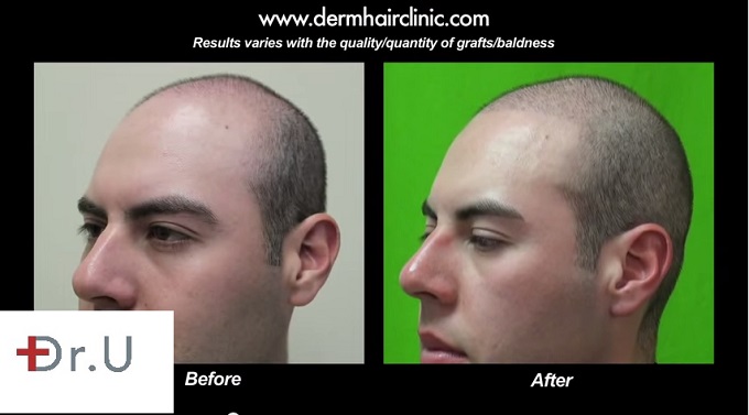 Three Quarters View of Patient's Results|Young Male Patient 2000 FUE Grafts