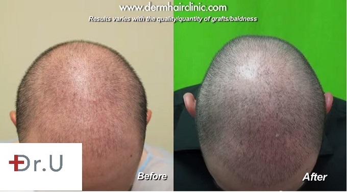 Top of FUE Patient's Head, before and after Conservative FUE Hair Transplant using 2000 grafts by UGraft with Dr U