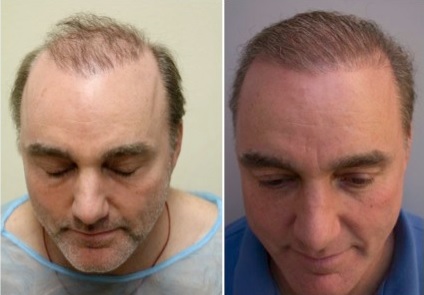 Beard Hair Transplant| Hair Transplant Repair|Patient Photos|Before and After