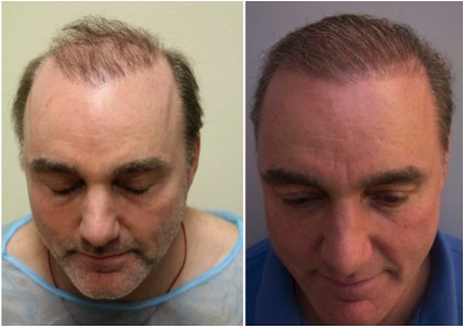 Differences Between UGraft advanced FUE and Traditional Hair Transplants : 5000 Graft Body Hair Transplant Surgery