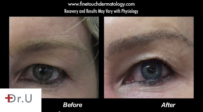 Eyebrow transplant with 350 Grafts Before and After Surgery