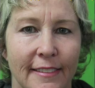 eyebrow transplant 1 eyebrow transplant 1
